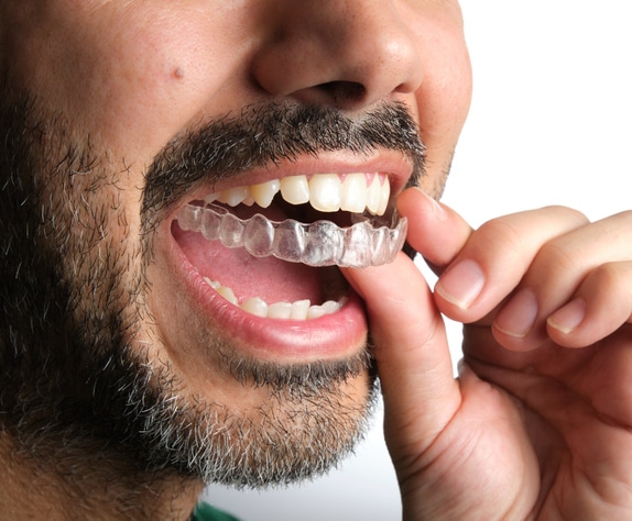 unrecognizable dark-haired man with beard putting on transparent dental retainer